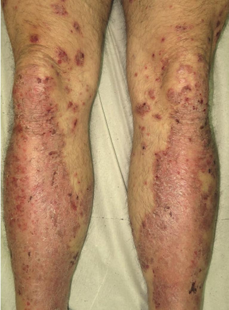 Management of immune checkpoint inhibitors-derived adverse events